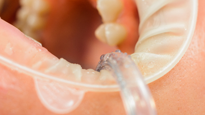 <i style='color:red'>中山伺服超声波塑料焊接机</i>：医用扩张器焊接生产中的创新应用